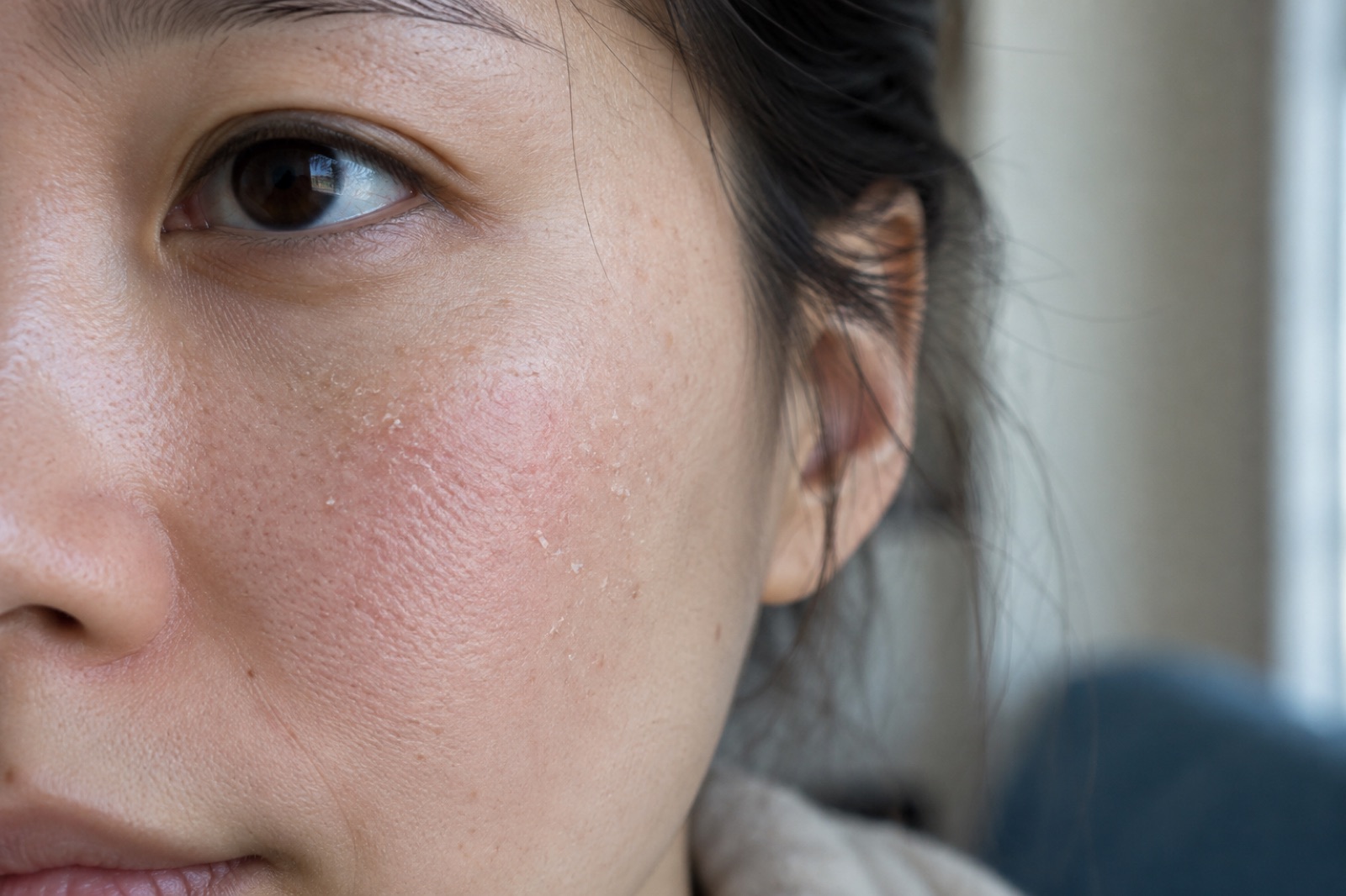 Close-up of the side of a face with flakes of white dead skin lifting on the cheek below the eye and a slight redness