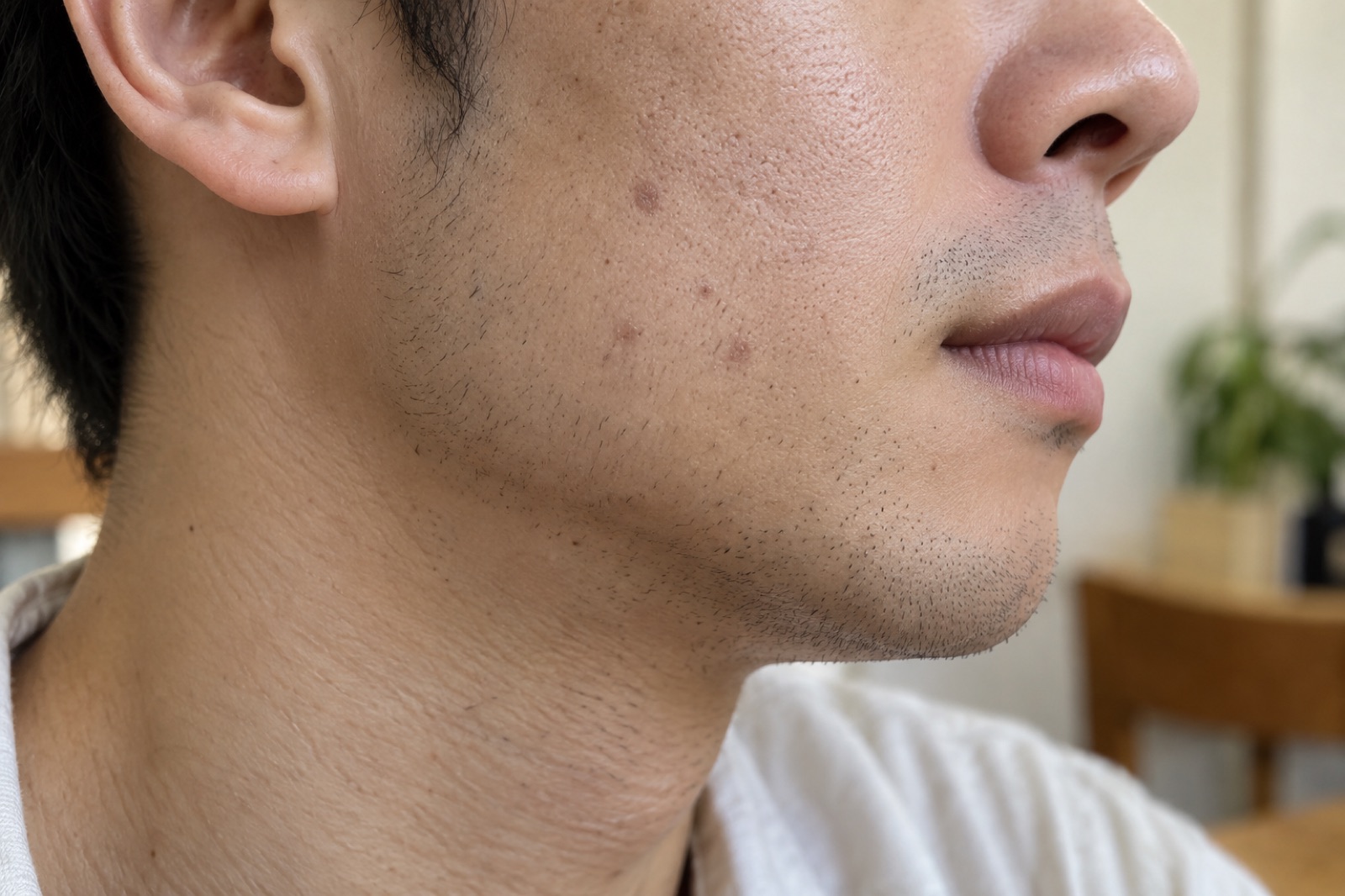 ใบหน้าด้านข้างระยะใกล้ของผู้ชายที่มีหนวดเคราสั้น มีรอยกลมสีน้ำตาลอ่อนอมชมพูสามสี่จุดบนแก้มใต้โหนกแก้ม